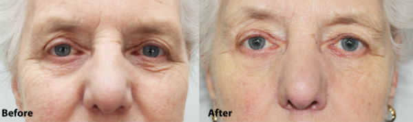 Caci Microlift Before and After