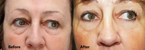 The wonder of the Caci Microlift